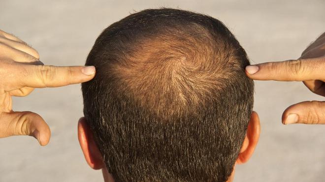 VIDÉO - Perte de cheveux : quels traitements et à quels prix ?