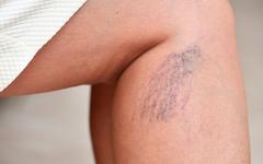Améliorez votre circulation : 5 exercices pour soulager les varices